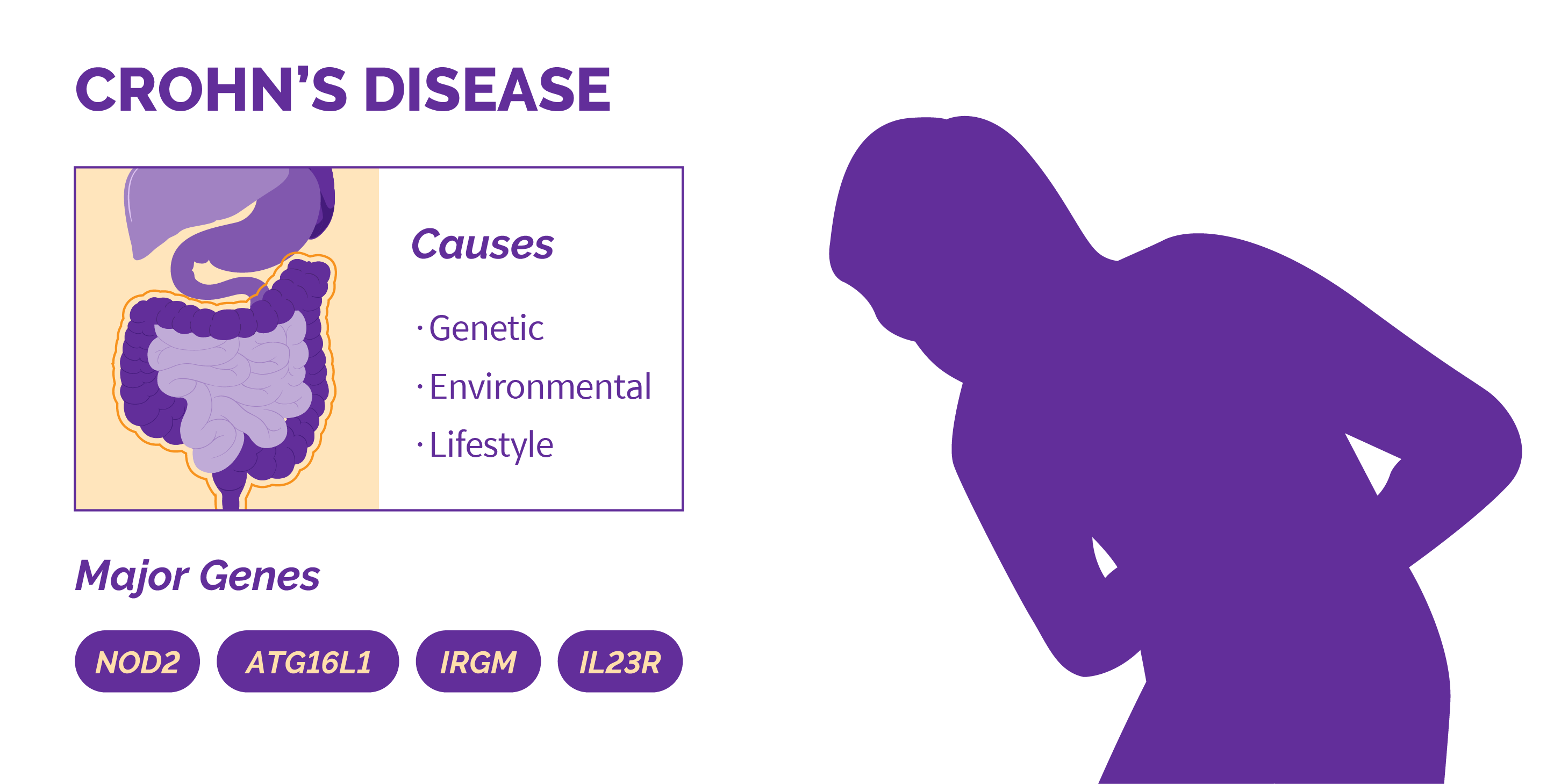 Crohn's disease is affected by genetic, environmental, and lifestyle factors. There are multiple genes related: NOD2, ATG16L1, IRGM, and IL23R