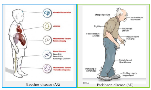 The GBA gene is associated with Gaucher disease with AR inheritance and susceptibility to Parkinson’s disease with AD inheritance